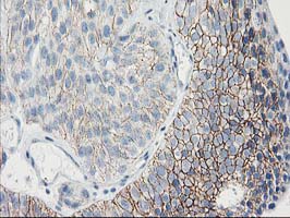 IHC of paraffin-embedded Carcinoma of Human bladder tissue using anti-GUK1 mouse monoclonal antibody. (Heat-induced epitope retrieval by 10mM citric buffer, pH6.0, 100C for 10min).