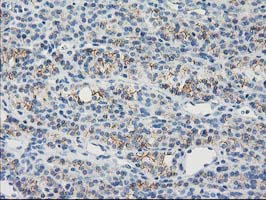 IHC of paraffin-embedded Carcinoma of Human thyroid tissue using anti-GUK1 mouse monoclonal antibody. (Heat-induced epitope retrieval by 10mM citric buffer, pH6.0, 100C for 10min).