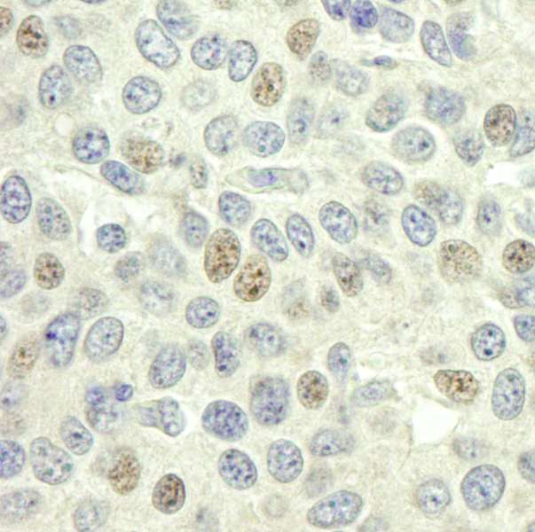 Detection of Human Geminin by Immunohistochemistry. Sample: FFPE section of human breast carcinoma. Antibody: Affinity purified rabbit anti-Geminin used at a dilution of 1:250.