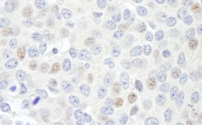Detection of Human Geminin by Immunohistochemistry. Sample: FFPE section of human breast carcinoma. Antibody: Affinity purified rabbit anti-Geminin used at a dilution of 1:5000 (0.2 Detection: DAB.