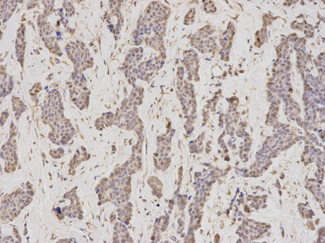 Immunohistochemistry of paraffin-embedded human breast cancer using GMNN antibody at dilution of 1:200 (200x lens).