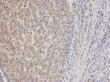 Immunohistochemistry of paraffin-embedded human liver cancer using GMNN antibody at dilution of 1:200 (200x lens).