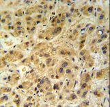 GNS Antibody (Center N189) IHC of formalin-fixed and paraffin-embedded human hepatocarcinoma followed by peroxidase-conjugated secondary antibody and DAB staining.