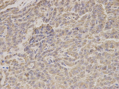 Immunohistochemistry of paraffin-embedded human thyroid cancer using HADHA antibody at dilution of 1:200 (400x lens).