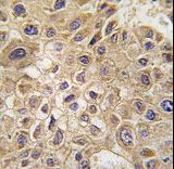Formalin-fixed and paraffin-embedded human hepatocarcinoma tissue reacted with AMFR Antibody , which was peroxidase-conjugated to the secondary antibody, followed by DAB staining. This data demonstrates the use of this antibody for immunohistochemistry; clinical relevance has not been evaluated.