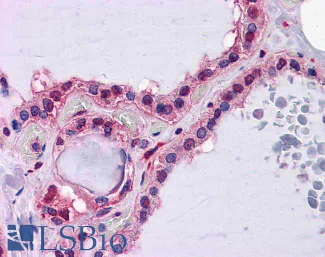 Anti-HAMP / Hepcidin antibody IHC of human thyroid. Immunohistochemistry of formalin-fixed, paraffin-embedded tissue after heat-induced antigen retrieval. Antibody LS-B4534 concentration 5 ug/ml.