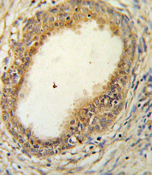 HAPLN1 Antibody IHC of formalin-fixed and paraffin-embedded prostate carcinoma followed by peroxidase-conjugated secondary antibody and DAB staining. This data demonstrates the use of the HAPLN1 Antibody for immunohistochemistry.