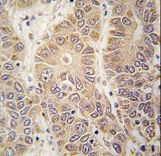 Formalin-fixed and paraffin-embedded human hepatocarcinoma tissue reacted with HARS antibody , which was peroxidase-conjugated to the secondary antibody, followed by DAB staining. This data demonstrates the use of this antibody for immunohistochemistry; clinical relevance has not been evaluated.