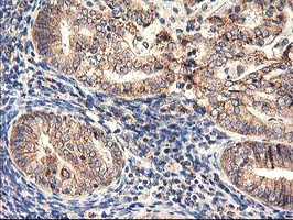 IHC of paraffin-embedded Adenocarcinoma of Human endometrium tissue using anti-HARS2 mouse monoclonal antibody.