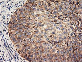 IHC of paraffin-embedded Carcinoma of Human bladder tissue using anti-HARS2 mouse monoclonal antibody.