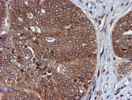 IHC of paraffin-embedded Adenocarcinoma of Human ovary tissue using anti-HARS2 mouse monoclonal antibody.