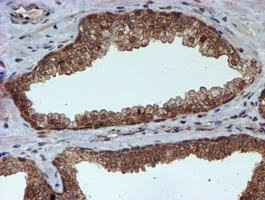 IHC of paraffin-embedded Carcinoma of Human prostate tissue using anti-HARS2 mouse monoclonal antibody.