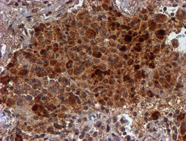 IHC of paraffin-embedded Carcinoma of Human lung tissue using anti-HARS2 mouse monoclonal antibody.
