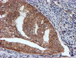 IHC of paraffin-embedded Adenocarcinoma of Human endometrium tissue using anti-HARS2 mouse monoclonal antibody.
