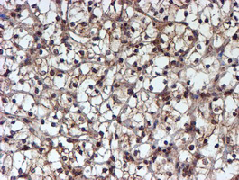 IHC of paraffin-embedded Carcinoma of Human kidney tissue using anti-HARS2 mouse monoclonal antibody.
