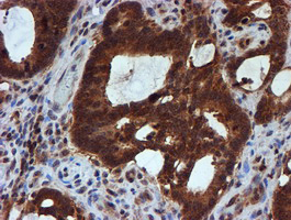 IHC of paraffin-embedded Adenocarcinoma of Human colon tissue using anti-HARS2 mouse monoclonal antibody.