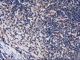 IHC of paraffin-embedded Human lymphoma tissue using anti-HARS2 mouse monoclonal antibody.