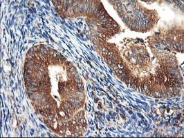 IHC of paraffin-embedded Adenocarcinoma of Human endometrium tissue using anti-HARS2 mouse monoclonal antibody.