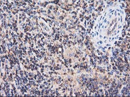IHC of paraffin-embedded Human lymphoma tissue using anti-HARS2 mouse monoclonal antibody.