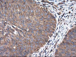 IHC of paraffin-embedded Carcinoma of Human bladder tissue using anti-HARS2 mouse monoclonal antibody.