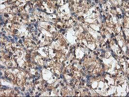 IHC of paraffin-embedded Carcinoma of Human kidney tissue using anti-HARS2 mouse monoclonal antibody.