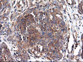 IHC of paraffin-embedded Adenocarcinoma of Human ovary tissue using anti-HARS2 mouse monoclonal antibody.
