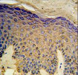 HAUS4 Antibody IHC of formalin-fixed and paraffin-embedded skin carcinoma followed by peroxidase-conjugated secondary antibody and DAB staining.