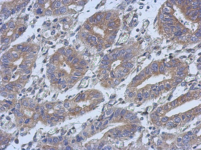 IHC of paraffin-embedded Colon ca, using C14orf94 antibody at 1:500 dilution.
