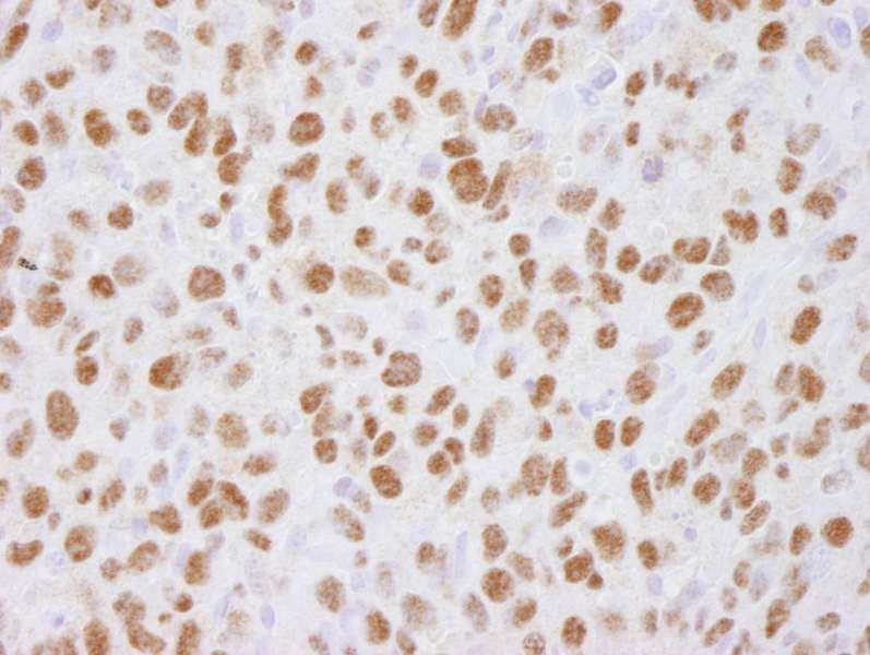 Detection of Mouse USP7 by Immunohistochemistry. Sample: FFPE section of mouse squamous cell carcinoma. Antibody: Affinity purified rabbit anti-USP7 used at a dilution of 1:100. Detection: DAB.