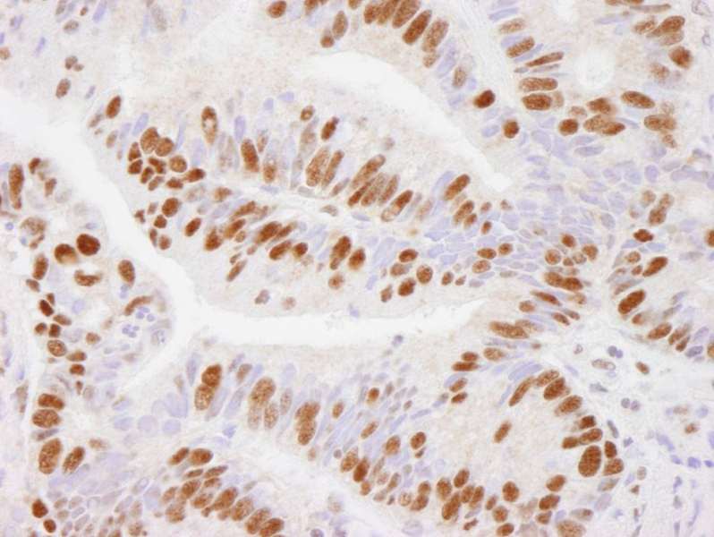 Detection of Human USP7 by Immunohistochemistry. Sample: FFPE section of human stomach adenocarcinoma. Antibody: Affinity purified rabbit anti-USP7 used at a dilution of 1:500. Detection: DAB.