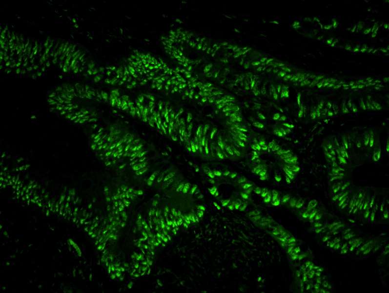 Detection of Human USP7 by Immunofluorescence. Sample: FFPE section of human colon adenocarcinoma. Antibody: Affinity purified rabbit anti-USP7 used at a dilution of 1:100. Detection: Green-fluorescent Anti-rabbit IgG-FITC conjugated used at a dilution of 1:100.