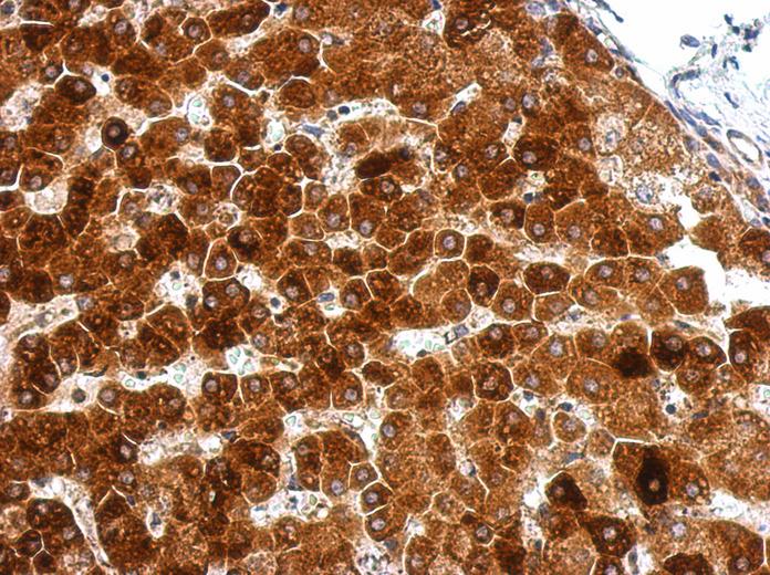 IHC of paraffin-embedded Hepatoma, using GPAA1 antibody at 1:500 dilution.