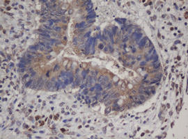IHC of paraffin-embedded Adenocarcinoma of Human colon tissue using anti-HBS1L mouse monoclonal antibody. (Heat-induced epitope retrieval by 10mM citric buffer, pH6.0, 100C for 10min).