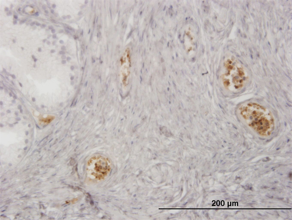Immunoperoxidase of monoclonal antibody to HBZ on formalin-fixed paraffin-embedded human prostate. [antibody concentration 3 ug/ml]