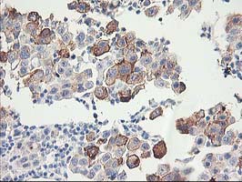 IHC of paraffin-embedded Carcinoma of Human lung tissue using anti-FAM119A mouse monoclonal antibody.