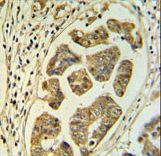 HCCS Antibody IHC of formalin-fixed and paraffin-embedded colon carcinoma followed by peroxidase-conjugated secondary antibody and DAB staining.
