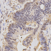 Immunohistochemistry of paraffin-embedded human rectal cancer using HCFC1 antibody at dilution of 1:200 (x400 lens)
