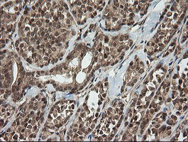 IHC of paraffin-embedded Carcinoma of Human thyroid tissue using anti-HCFC2 mouse monoclonal antibody.