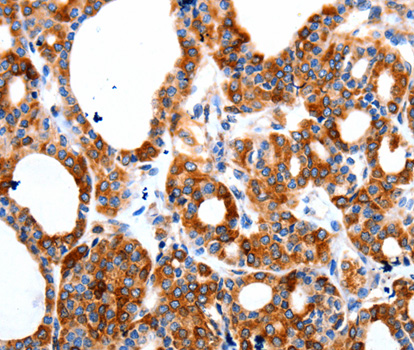 Immunohistochemistry of paraffin-embedded human thyroid cancer tissue using HCN1 antibody.