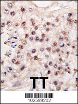 Formalin-fixed and paraffin-embedded human testicle tumor tissue reacted with HDAC11 antibody , which was peroxidase-conjugated to the secondary antibody, followed by DAB staining. This data demonstrates the use of this antibody for immunohistochemistry; clinical relevance has not been evaluated.