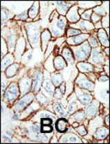 Purified rabbit anti-HDAC11 antibody was used in immunohistochemistry on Breast Carcinoma.