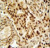 HDAC2 Antibody immunohistochemistry of formalin-fixed and paraffin-embedded human lung carcinoma followed by peroxidase-conjugated secondary antibody and DAB staining.