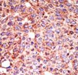 Formalin-fixed and paraffin-embedded human cancer tissue reacted with the primary antibody, which was peroxidase-conjugated to the secondary antibody, followed by AEC staining. This data demonstrates the use of this antibody for immunohistochemistry; clinical relevance has not been evaluated. BC = breast carcinoma; HC = hepatocarcinoma.