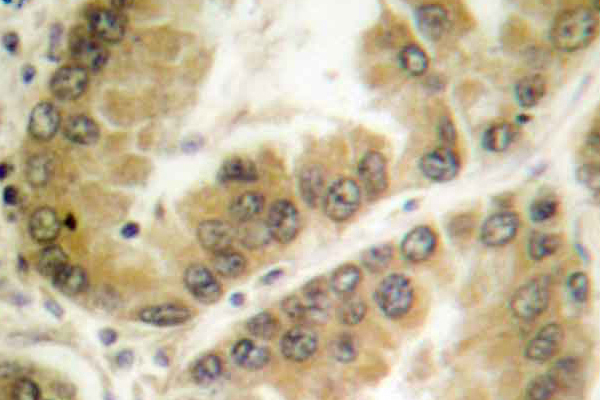 IHC of HDAC7 (G932) pAb in paraffin-embedded human lung carcinoma tissue.