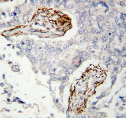 HDAC8 antibody. IHC(P): Human Lung Cancer Tissue.