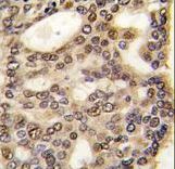 Formalin-fixed and paraffin-embedded human hepatocarcinoma tissue reacted with HDGF antibody , which was peroxidase-conjugated to the secondary antibody, followed by DAB staining. This data demonstrates the use of this antibody for immunohistochemistry; clinical relevance has not been evaluated.