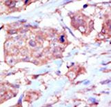 Formalin-fixed and paraffin-embedded human cancer tissue reacted with the primary antibody, which was peroxidase-conjugated to the secondary antibody, followed by DAB staining. This data demonstrates the use of this antibody for immunohistochemistry; clinical relevance has not been evaluated. BC = breast carcinoma; HC = hepatocarcinoma.
