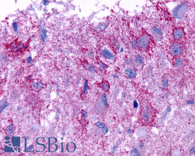 Anti-GPCR6 / GPR101 antibody IHC of human Brain, Glioblastoma. Immunohistochemistry of formalin-fixed, paraffin-embedded tissue after heat-induced antigen retrieval.