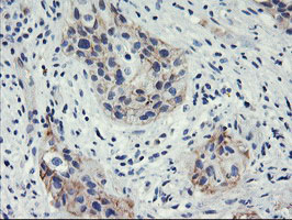 IHC of paraffin-embedded Carcinoma of Human bladder tissue using anti-HES1 mouse monoclonal antibody.