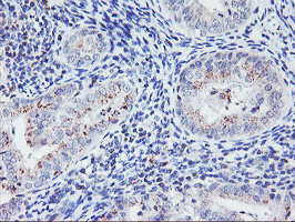 IHC of paraffin-embedded Adenocarcinoma of Human endometrium tissue using anti-HES1 mouse monoclonal antibody.